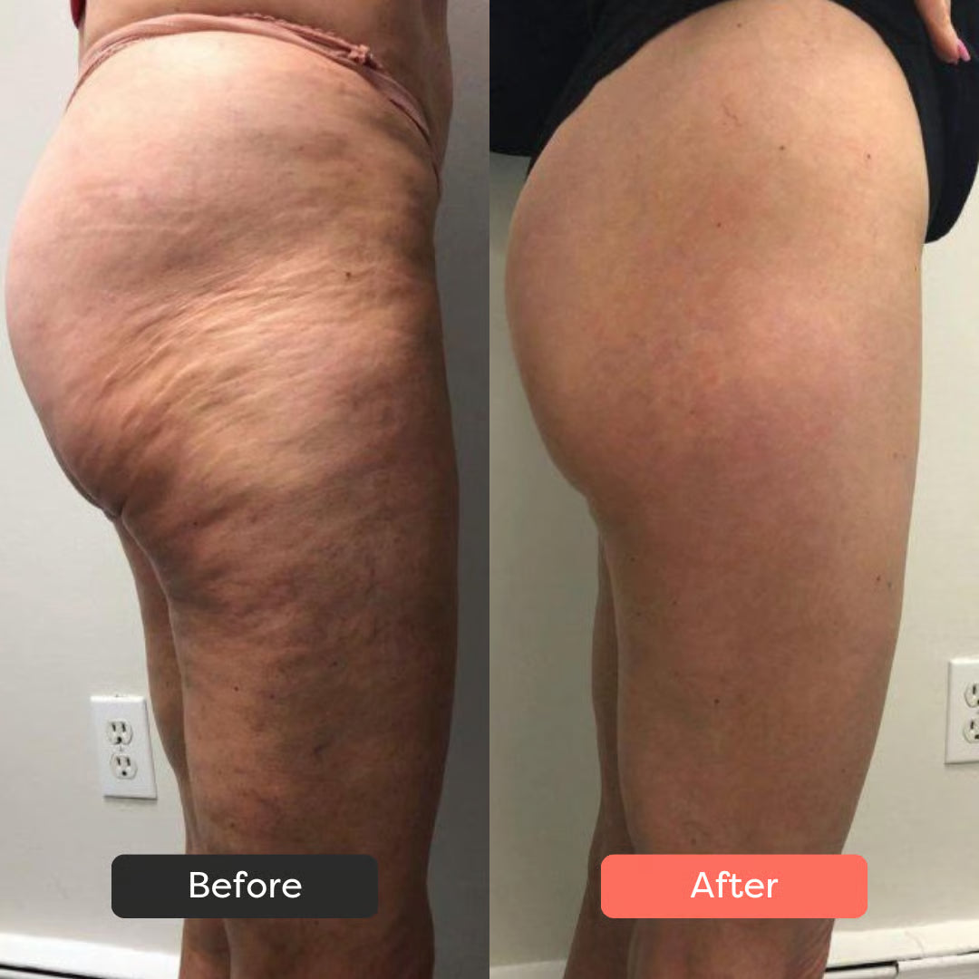 Urządzenie Modelujące Ciało 3w1™ Evelano ThermoSlim Pro EVELANO